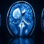 Neuroendoscopy